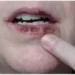Actinic Keratosis Lips showing sun-damaged lips, dryness, scaling, and skin care