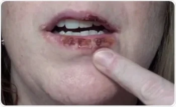 Actinic Keratosis Lips showing sun-damaged lips, dryness, scaling, and skin care