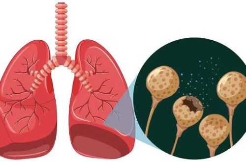 Living Well with Bronchiectasis