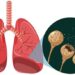 Living Well with Bronchiectasis