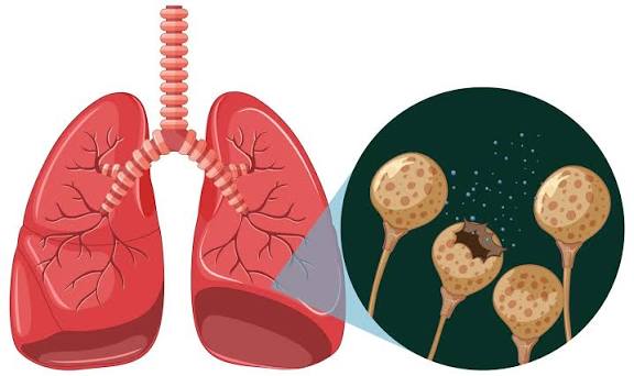 Living Well with Bronchiectasis