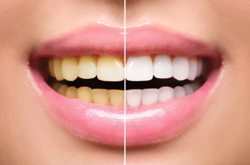 Teeth Whitening
