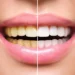 Teeth Whitening