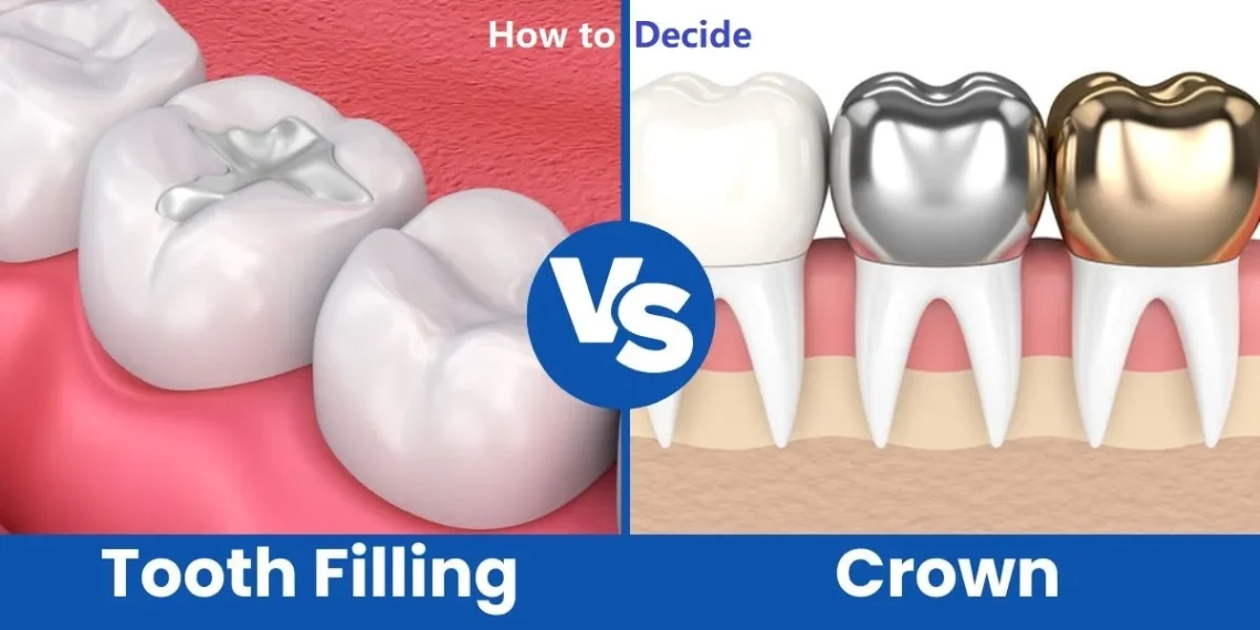 Crown or Filling? How to Know Which Your Tooth Really Needs