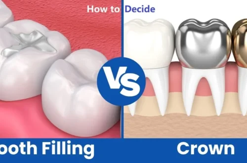 Crown or Filling? How to Know Which Your Tooth Really Needs