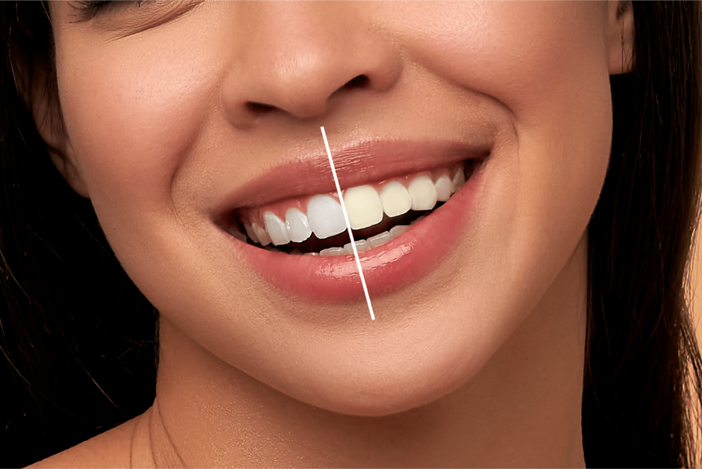 Teeth Whitening