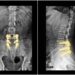 lumbar spine surgery Al Ain