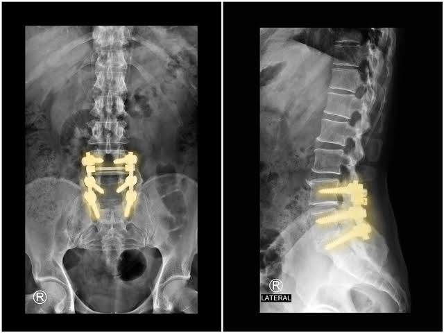 lumbar spine surgery Al Ain