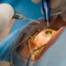 cataract surgery in delhi ncr