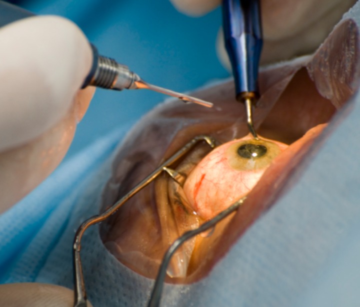 cataract surgery in delhi ncr