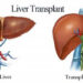 liver transplant cost in noida