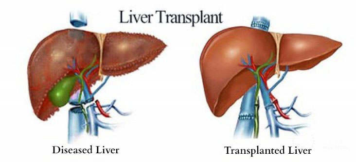 liver transplant cost in noida
